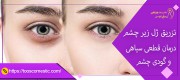 تزریق ژل زیر چشم درمان قطعی سیاهی و گودی چشم